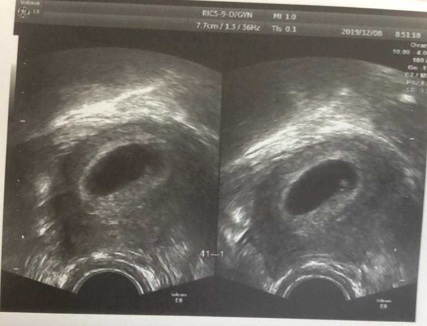 试管婴儿着床后为什么会出血？