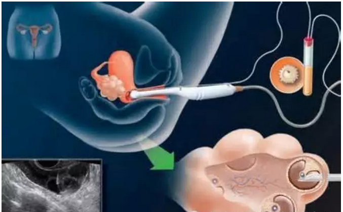 做试管婴儿取卵后怎么做卵巢恢复得快