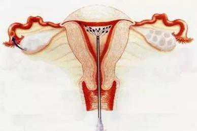 为什么试管婴儿可以“一步到位”，医生还建议我先做人工授精？