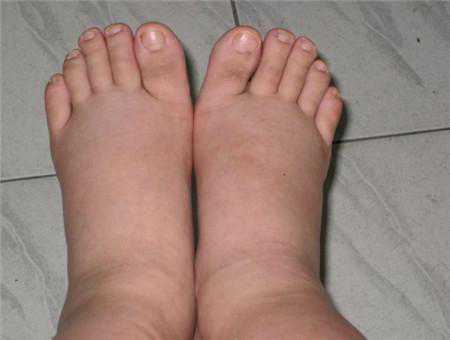 孕期她的脚越来越肿，婆婆觉得她可能怀男宝！