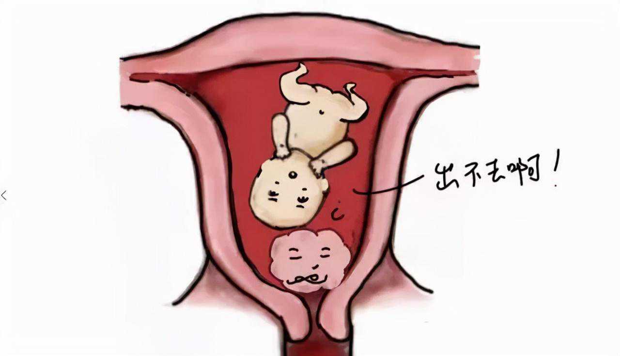 孕期遇上巨大子宫肌瘤，娃还能生吗？医生建议...
